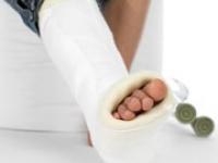  gips, gipsfuss, unfall